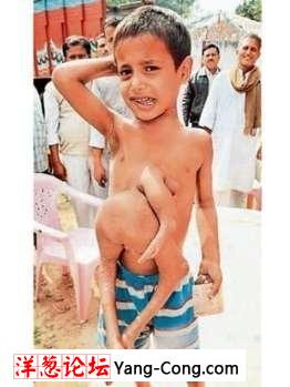 印度8岁男孩肚子上长2条腿和1支胳膊(图)