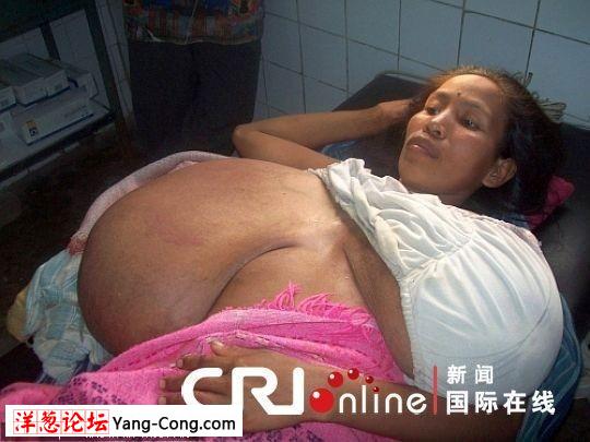 秘鲁少妇患上巨乳症:乳房重达32斤 缩胸手术成功(组图)