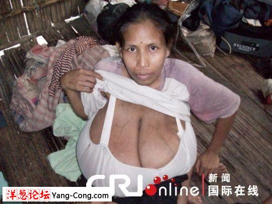 秘鲁少妇患上巨乳症:乳房重达32斤 缩胸手术成功(组图)