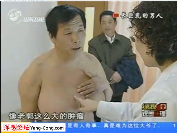 实拍长巨乳的波霸男人:神奇乳房大如篮球 动手术摘除(视频组图58P)