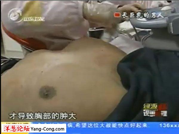 实拍长巨乳的波霸男人:神奇乳房大如篮球 动手术摘除(视频组图58P)