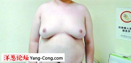 19岁男孩患乳腺增生 巨乳房重达10斤被手术切除(组图)