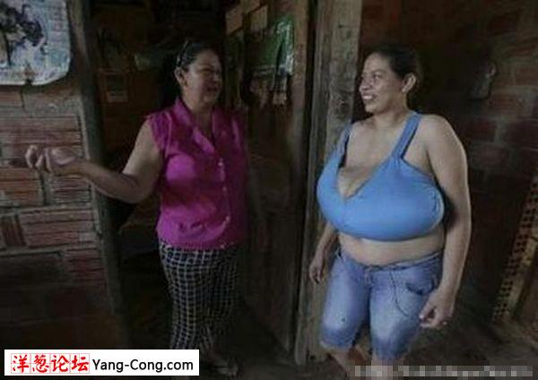 玻利维亚女人巨乳重达10磅 不断增长危及生命(组图)