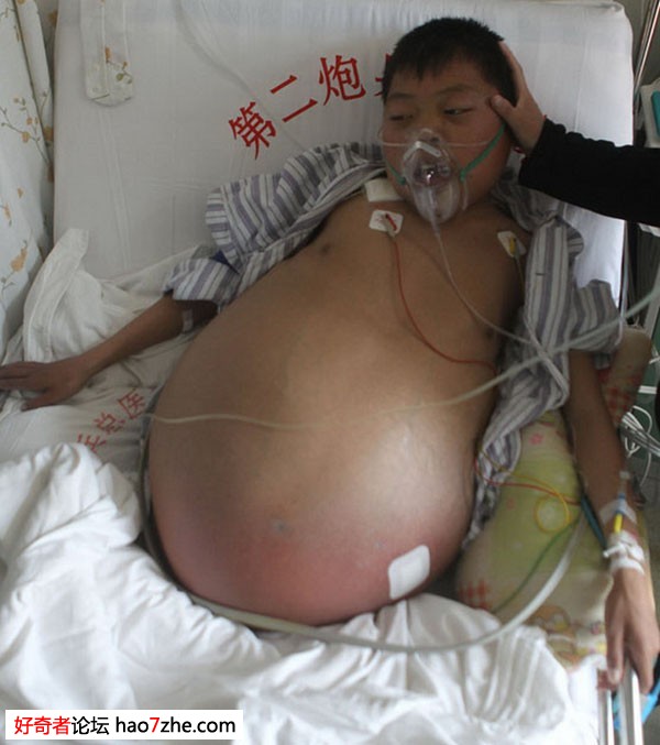 沧州20岁男孩得恐怖大肚子怪病:腹围140厘米 病因未查明(高清组图)