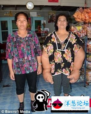泰女子患罕见病：大量脂肪堆积出世界最大手臂(4)