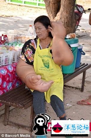 泰女子患罕见病：大量脂肪堆积出世界最大手臂(2)