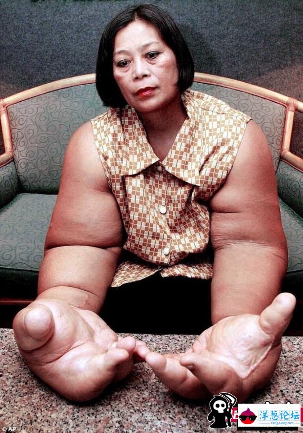 泰女子患罕见病：大量脂肪堆积出世界最大手臂(2)