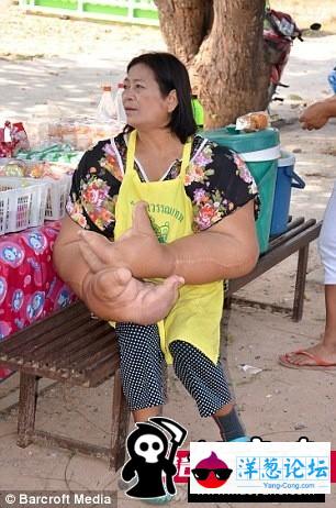 泰女子患罕见病：大量脂肪堆积出世界最大手臂(3)