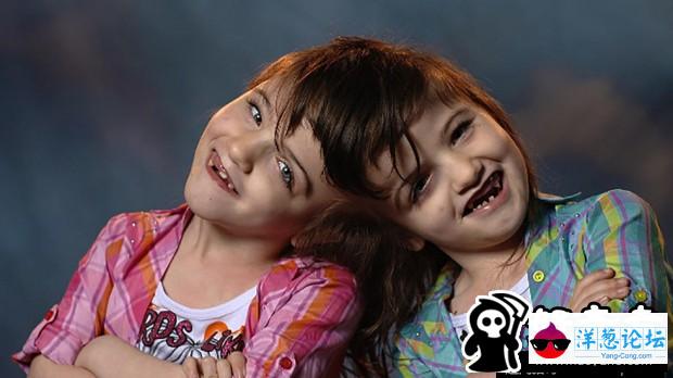 加拿大7岁连体婴姐妹共用一个大脑(6)