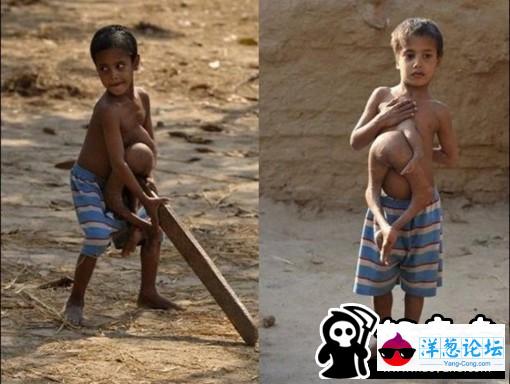 举世罕见的印度怪胎： 长着4条腿和3支手臂的印度男孩
